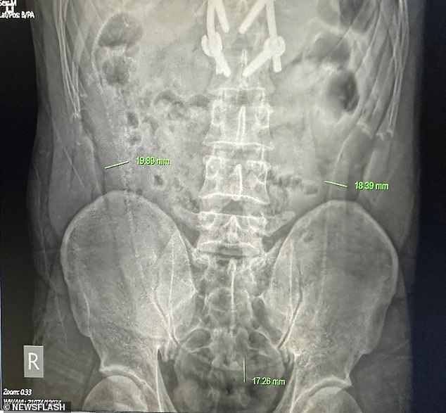 Horrified doctors in Vietnam discovered the 26-inch-long eel in X-rays taken to diagnose the cause of her pain on July 27.