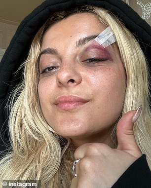 Rexha was left bruised and bloodied after the phone cut her eyebrow and left her with a black eye in June 2023.