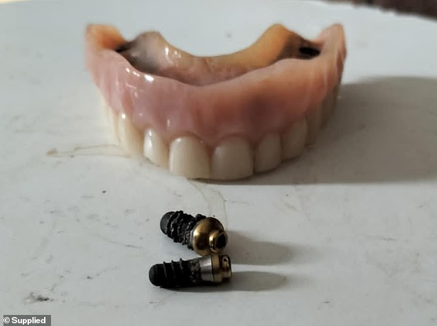 After the attack, Ms Glynn had to have her entire top row of teeth removed and implants fitted, but the screws (pictured) holding them to her jaw came loose just a year later.