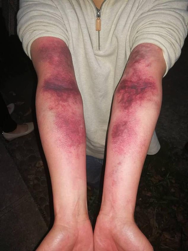 Many doctors have criticized this practice, saying that it causes bruising and leads to rupture of blood vessels, leading to horrible injuries like those pictured above.