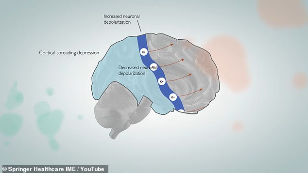 Before some people feel a migraine, their vision is disrupted. This happens when a wave of signals passes through the brain, as in the illustrated diagram. With these signals, a fluid carrying migraine-causing proteins is diverted out of the brain and toward pain receptors.