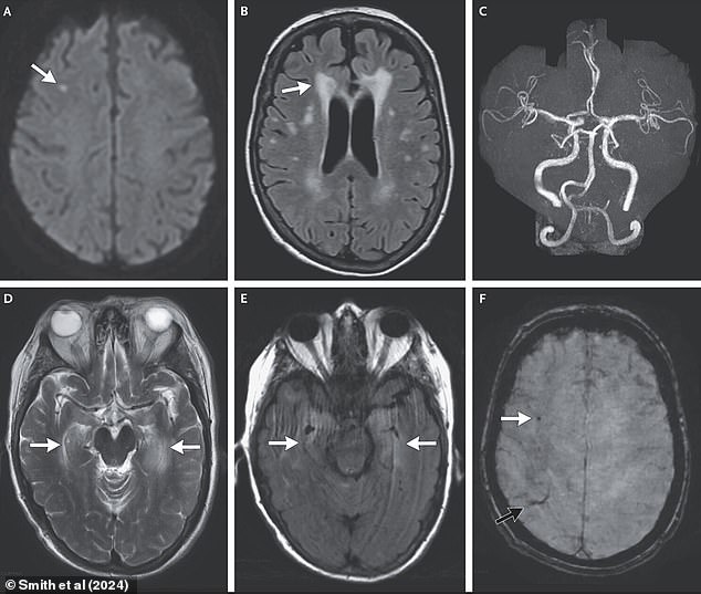 Previous brain scans suggest a stroke, damage to brain tissue and narrowing of the brain's vessels.