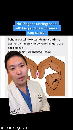 Seattle dermatologist Dr. Daniel Sugai said on TikTok that he recommends testing for clubbing.