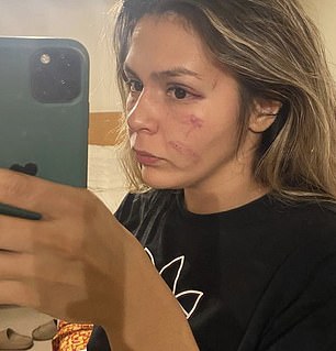 Mexican fighter Brianda Tamara showed her injuries from fighting Khelif in 2022