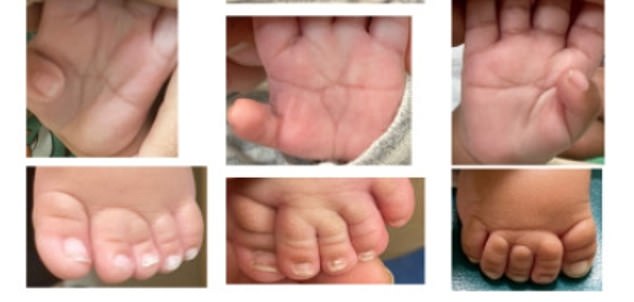 Some of the babies also had wider thumbs than normally seen, as well as a single horizontal crease in their palms instead of the normal two.