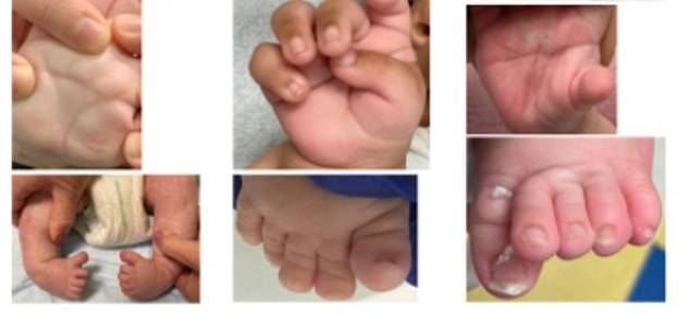 Several babies had fused fingers and rounded, beak-shaped feet. 