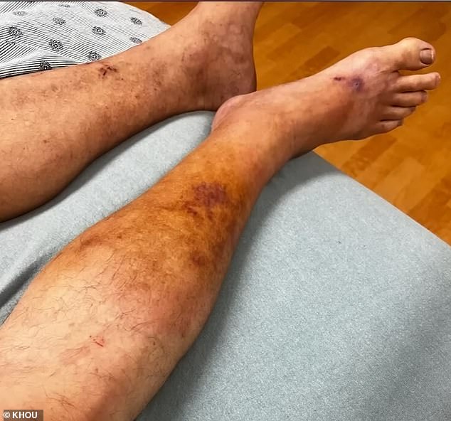 A scrape he had suffered earlier became infected with the flesh-eating bacteria, which is commonly found in the Gulf. The infection on Bunch's leg spread in the days before his death.