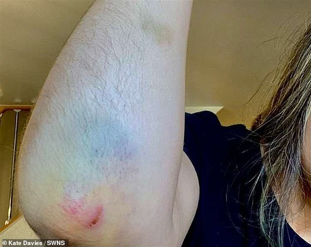 Kate's scratches and bruises after the incident at Dreamland Margate