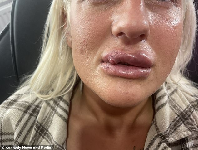 The mother of two had been using filler and anti-wrinkle injections for the past ten years without any problems, but these injections caused her cheeks to swell and eventually her lips.