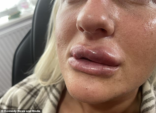 Worried about a possible infection, she went back to her doctor, who advised her to go to the hospital, where she was told that part of her cheek would have to be cut away. But two weeks later, her lips were also swollen.