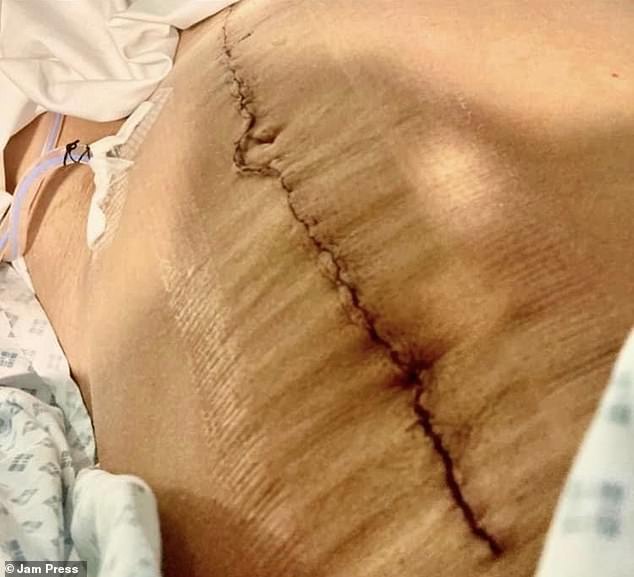 Ms Boswell, who initially suffered from back pain and symptoms of irritable bowel syndrome, thought the lump was simply due to her age and other symptoms due to her active lifestyle. But after her aforementioned diagnosis in August 2022, she underwent emergency surgery to remove the tumour completely.