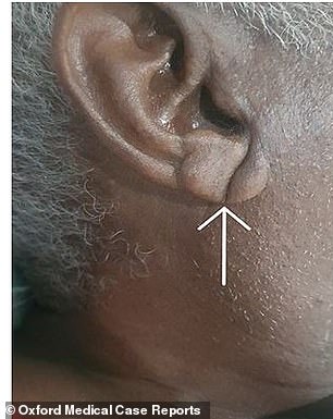 The reason why people with heart disease may develop this crease is not fully understood, but it could be due to changes in the small blood vessels that supply the ears.