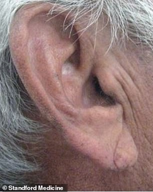 There may also be a genetic reason: those who are predisposed to heart disease also have genes that code for wrinkles and creases in the earlobes.