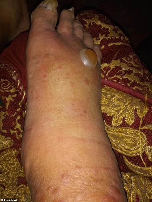 After Adam Perez dipped his toes in some water at a Corpus Christi park, his foot and leg swelled massively and a giant blister formed, due to vibriosis.