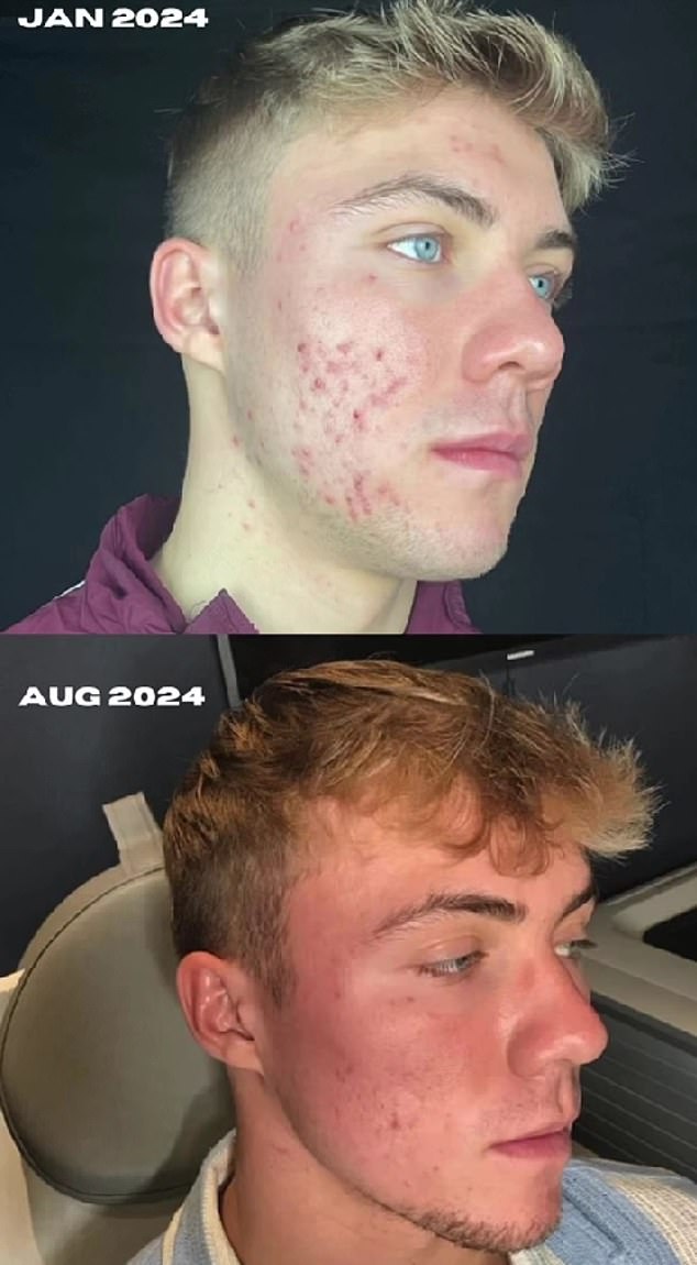 Forward acne is healing after three rounds of PicoSure laser skin resurfacing treatment