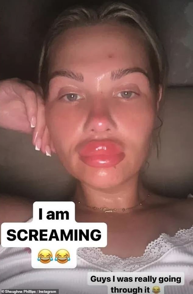 The former Love Island star, 30, took to social media to show off the swelling she suffered following the cosmetic procedure.