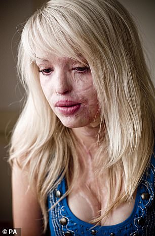 Katie (pictured in 2009) suffered horrific injuries after Stefan Sylvestre threw acid on her in 2008.