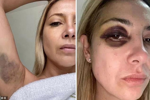 Photos leaked last week by the online news portal Infobae revealed the alleged abuse that Yáñez suffered during the government of former President Alberto Fernández in 2021. The images were released after Yáñez accused Fernández of domestic violence.