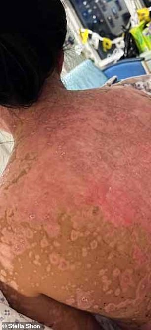 Shown above are the painful rashes on her back as her skin peeled off in layers.