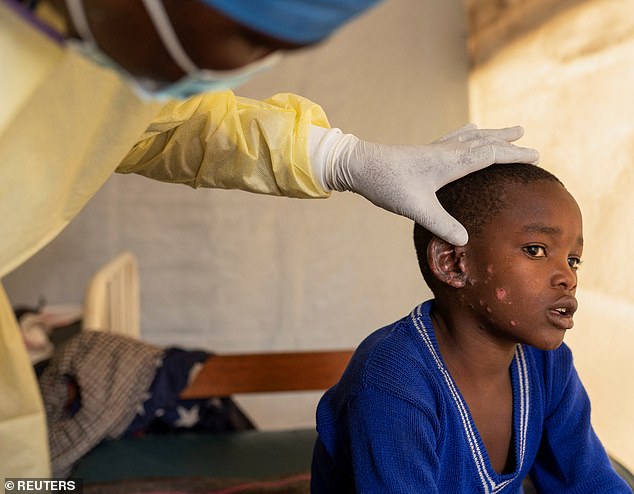 A child with skin lesions receives treatment at the Munigi treatment centre, Democratic Republic of Congo, on July 19.