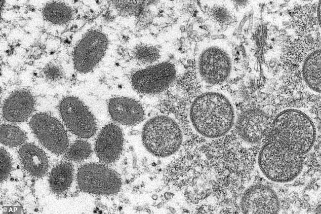 Mpox virions shown under a microscope. Experts warn that the new clade 1b is harder to detect