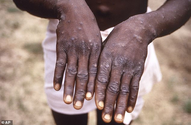 A 1997 image shows MPOX symptoms in a patient in the Democratic Republic of the Congo, formerly Zaire.