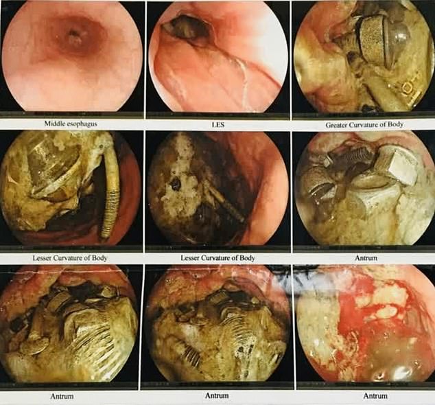 An endoscopy, where a small, flexible camera is inserted into the throat, also confirmed the metal mass.