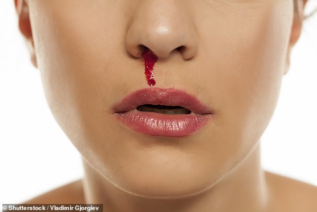 The best way to stop a nosebleed is to lean forward and pinch the tip of your nose for 15 minutes, according to NHS advice.