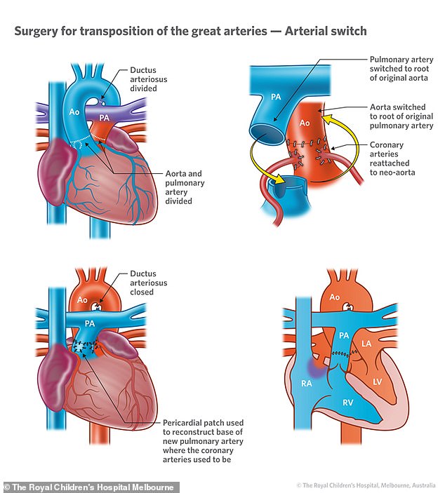 Dextrotransposition of the great arteries (D-TGA) is a rare and serious congenital heart defect in which the main arteries (pulmonary and aorta) are reversed.