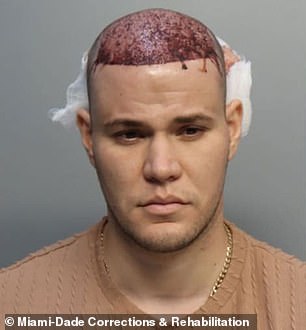 Hernandez-Garnier's mugshot shows him unbandaged and with blood pouring from his scalp after his hair transplant.