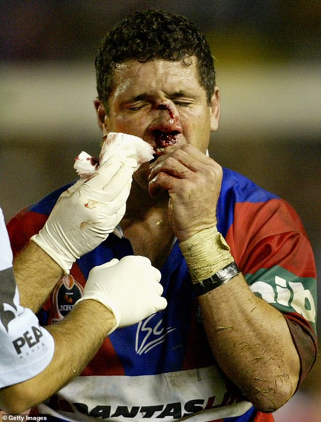 O'Davis was known for his aggressive approach to the game and suffered a particularly horrific injury that left his nose crushed and his palate broken after an on-field collision in 2003.