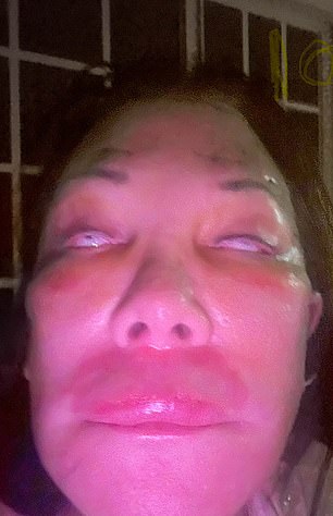 Dian Keller, 70, of Florida, paid $13,000 for a partial facelift, but said that as soon as she woke up she began to 