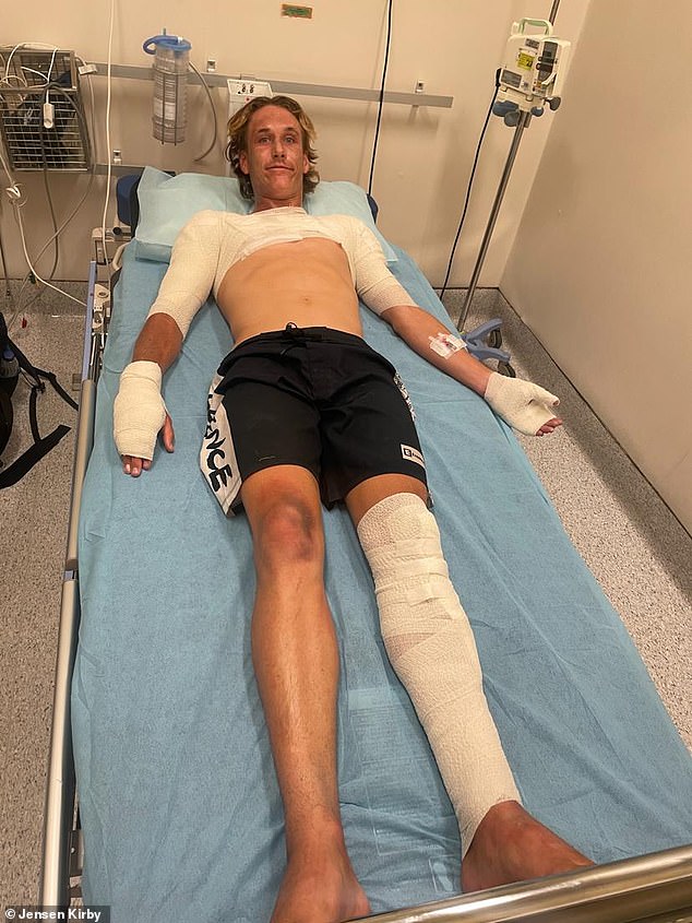 The young surfer suffered severe burns to his face, chest, arms, hands and legs (pictured)