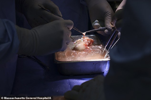 This year, in a groundbreaking operation, a 62-year-old man in the United States became the first living person to receive a genetically modified kidney from a pig. Pictured: Surgeons at Massachusetts General Hospital in Boston preparing the pig kidney for transplant in March 2024