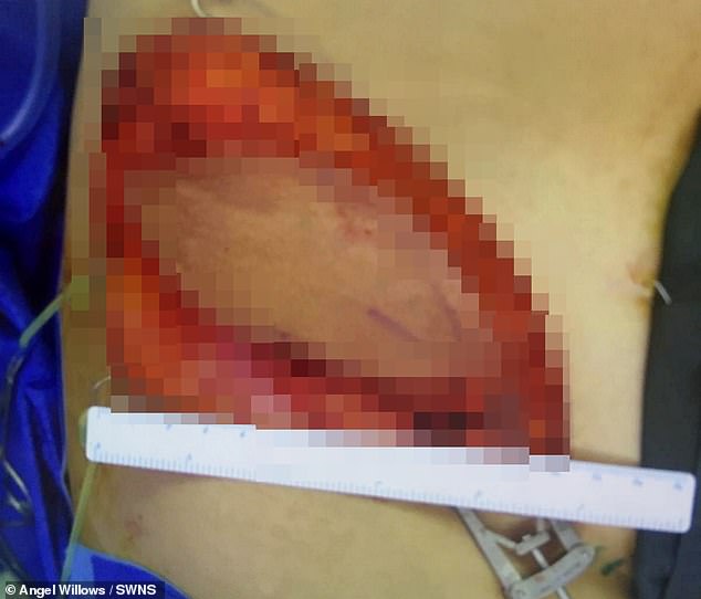 Flesh and skin were removed from his groin area.