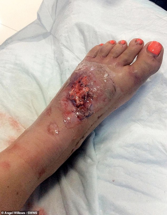 Australian doctors had to graft skin and flesh onto his left foot.