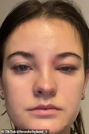 Last December, Dance Moms star Brooke Hyland, 25, accidentally popped a pimple on this triangle and ended up with an infected eye as a result.