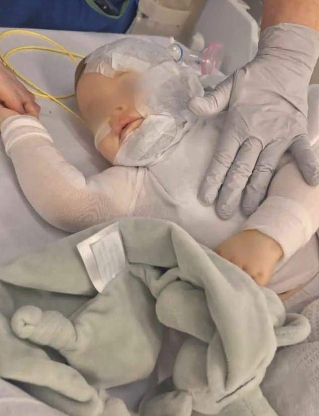 The mother of a severely burned baby (pictured) has revealed her biggest fear and said she is having panic attacks as a stranger who poured scalding coffee on her nine-month-old son remains at large.