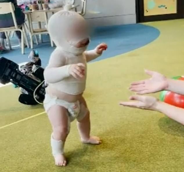 The boy had walked unaided for the first time just hours before he was burned at a picnic in the park, his parents said.