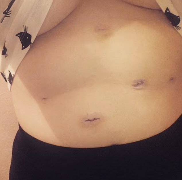 Multiple surgeries left several scars on her abdomen.