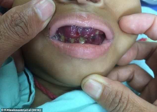 The image above shows a patient with scurvy and severe gum overgrowth.