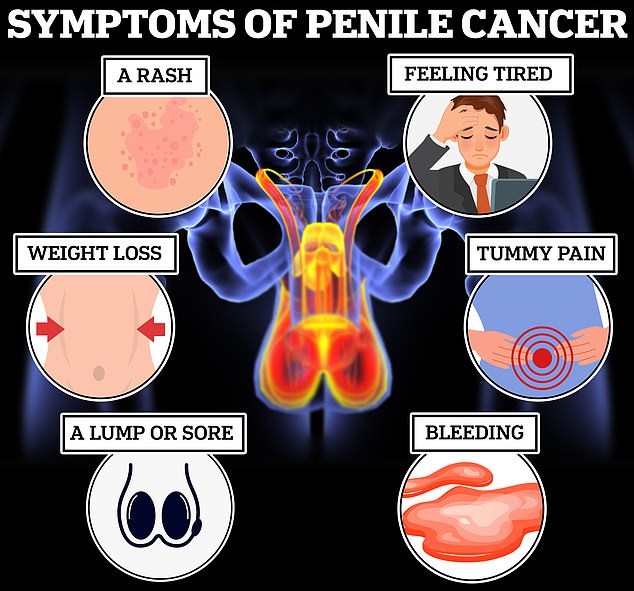 Penile cancer is rare in the UK, with only about 760 new cases diagnosed each year, according to Cancer Research UK. But cases are predicted to rise to 1,100 a year in the UK by 2038-2040. A growth or sore on the penis, a foul-smelling discharge, bleeding, a rash or difficulty retracting the foreskin are all telltale signs of cancer.