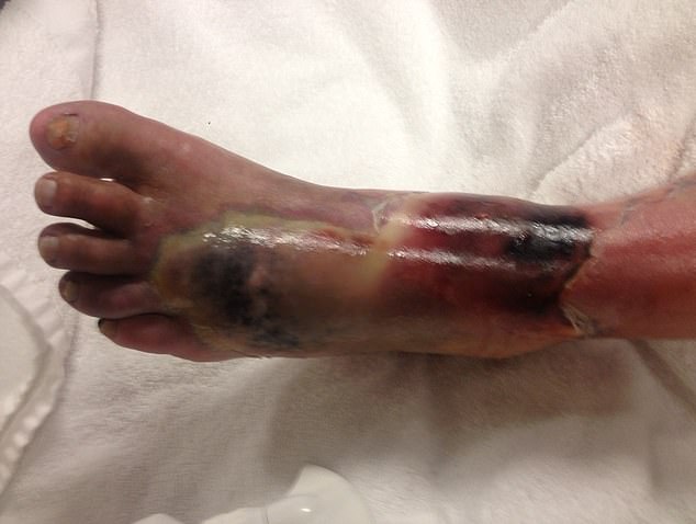 It took nurses more than a week to act on her growing necrotising fasciitis infection (pictured) and finally call a surgeon.