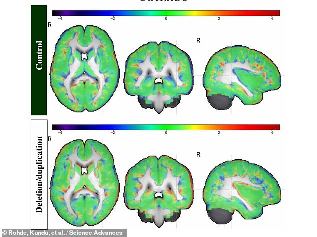 Above, brain scan data comparing a control brain without autism (top row) with a brain containing deletions or duplications of genetic material linked to autism (bottom row). 