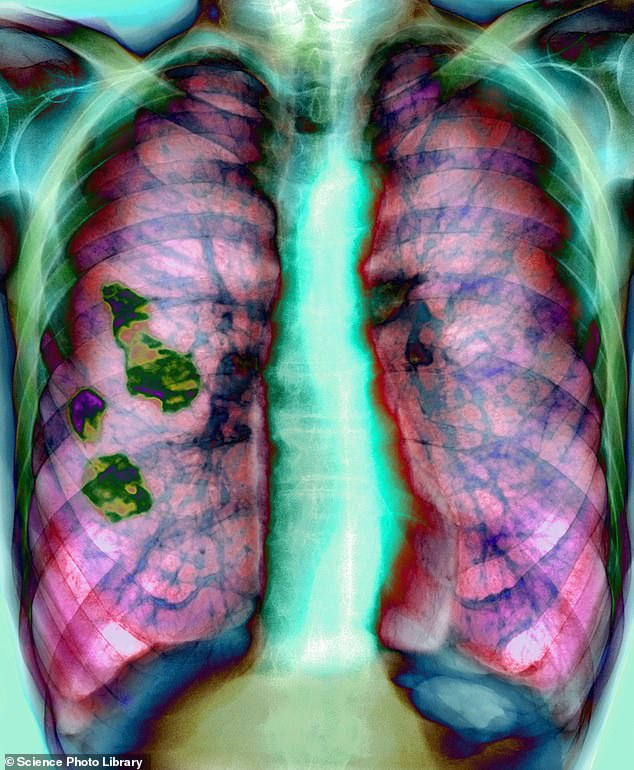 Emphysema occurs when the tiny alveoli (or air sacs) inside the lungs become damaged and stop working properly. Chronic bronchitis is a long-term inflammation of the airways, and many people have both conditions, so they are not referred to under the same general term.