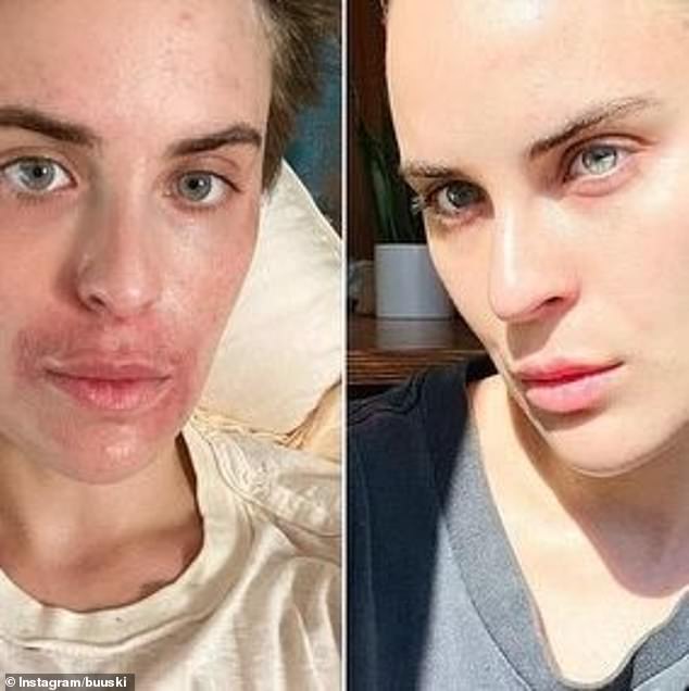 In June, she took to Instagram to share incredible before and after photos of her face. 