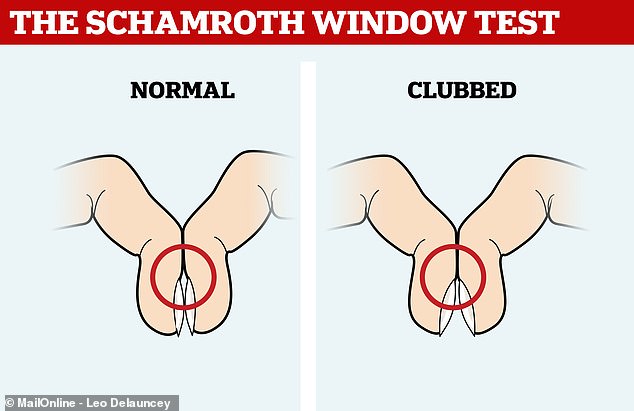 Healthy people should have a diamond-shaped gap between their nails when they press them together. If that gap disappears, it could be a sign that someone has clubbing of the fingers, which is a symptom of lung cancer.