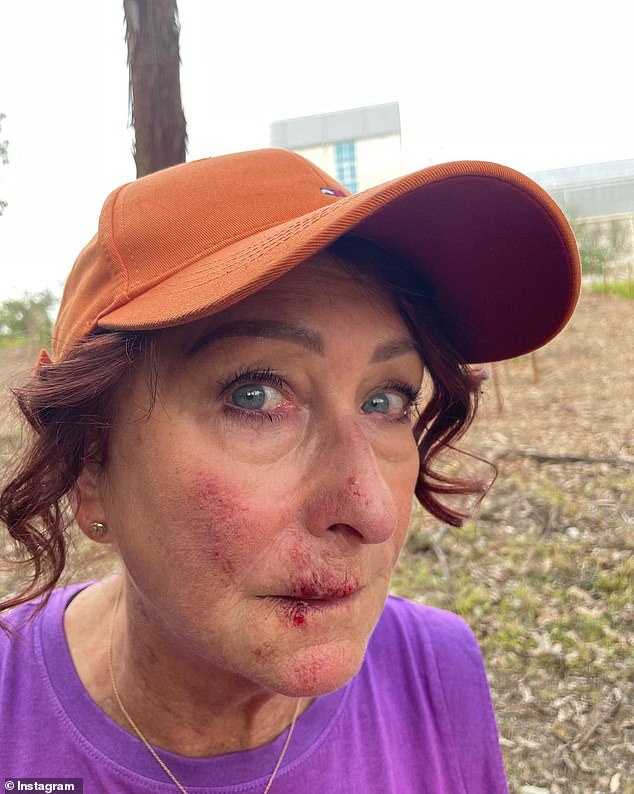 This isn't the first time Lynne has sparked concern after sharing an image of herself in pain, but the last time was real. Last year, she posted a photo in which she had scrapes on her nose, right cheek and chin after a nasty fall.