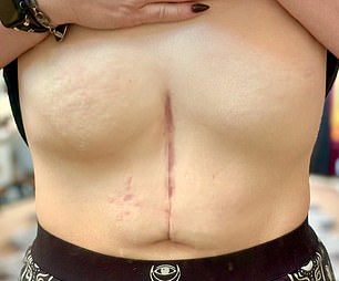 Ms Oyen was left with a large scar on her abdomen from surgery to remove her oesophagus.