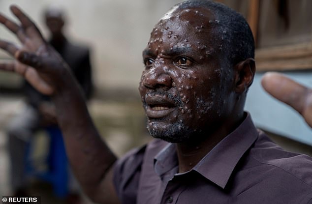 Jean Kakura Biyambo, a father of six from Muja IDP camp in the Democratic Republic of Congo, gestures from a general hospital where he has been receiving treatment for mpox, on July 16.